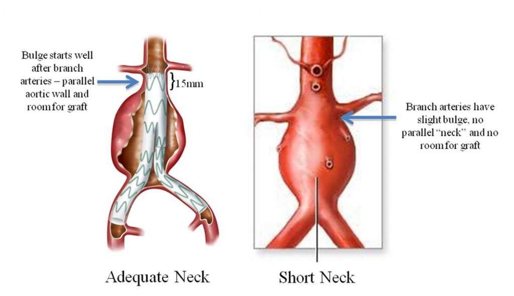 Nearly half of the 40,000 patients who undergo elective repair of aortic aneurysms do not have enough room for a graft between the aneurysm and the branch arteries.