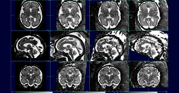 Fetal MRI